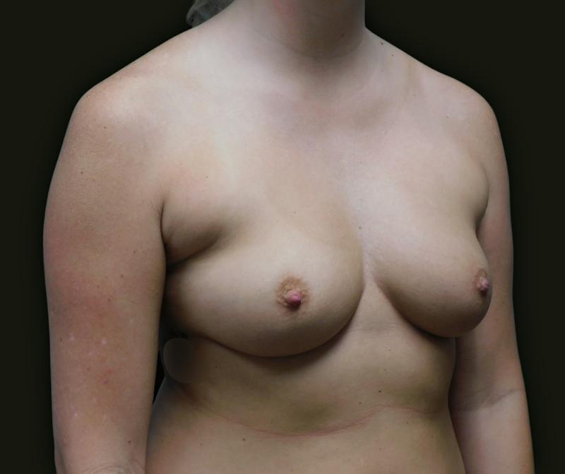Breast Augmentation Before & After Gallery - Patient 121343 - Image 3