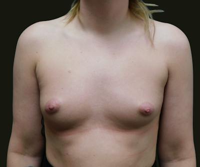 Breast Augmentation Before & After Gallery - Patient 337802 - Image 1
