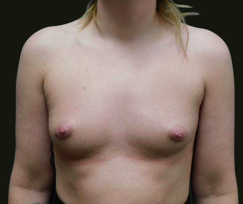 Breast Augmentation Before & After Gallery - Patient 337802 - Image 1