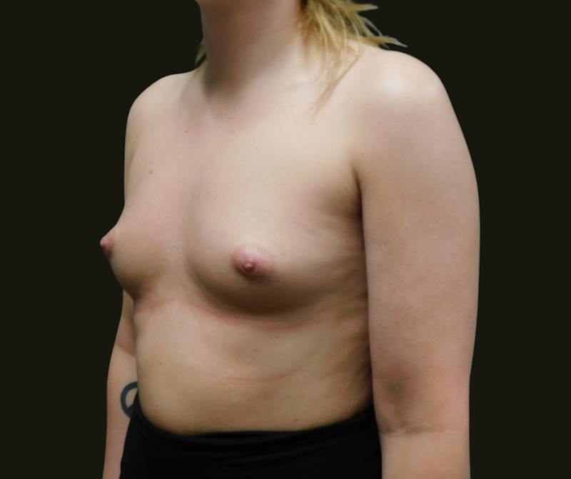 Breast Augmentation Before & After Gallery - Patient 337802 - Image 3