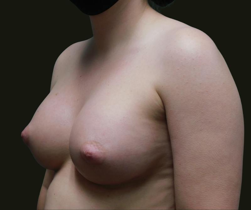 Breast Augmentation Before & After Gallery - Patient 337802 - Image 4