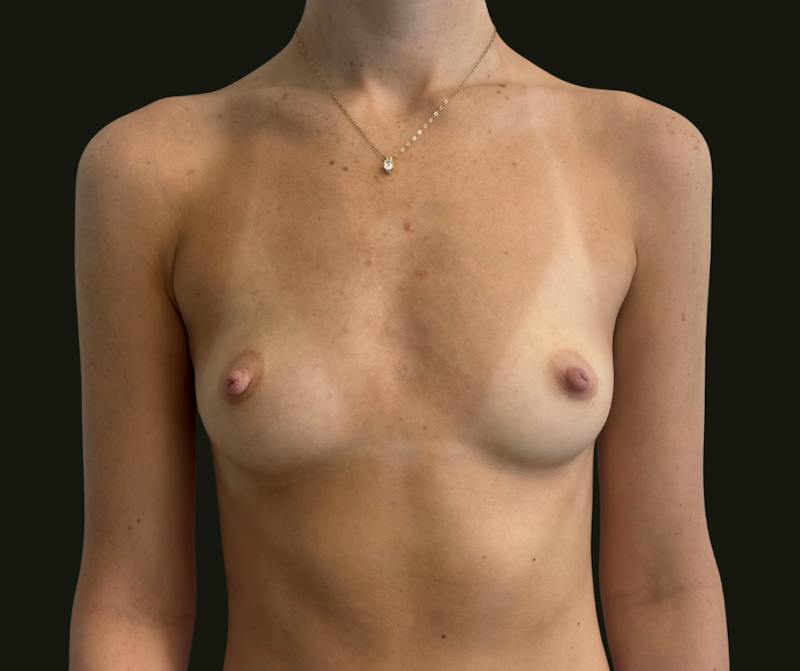 Breast Augmentation Before & After Gallery - Patient 311742 - Image 1