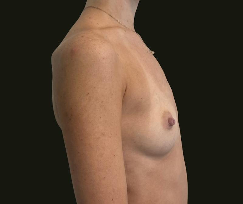 Breast Augmentation Before & After Gallery - Patient 311742 - Image 3