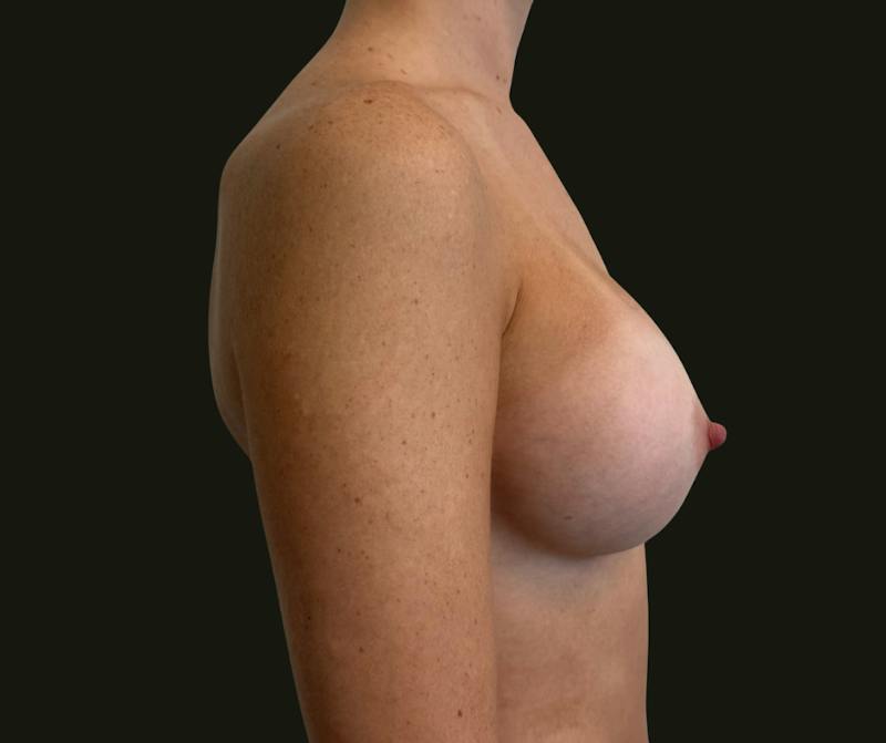 Breast Augmentation Before & After Gallery - Patient 311742 - Image 4