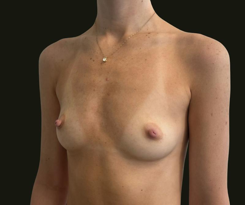 Breast Augmentation Before & After Gallery - Patient 311742 - Image 5