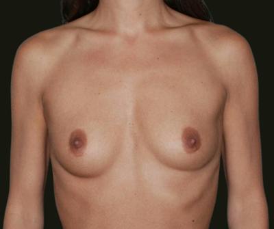 Breast Augmentation Before & After Gallery - Patient 173408 - Image 1