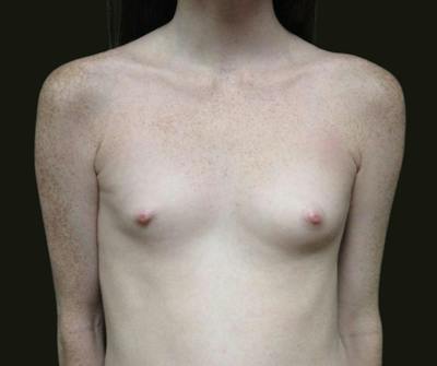 Breast Augmentation Before & After Gallery - Patient 615407 - Image 1