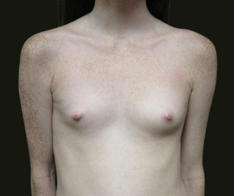 Breast Augmentation Before & After Gallery - Patient 615407 - Image 1
