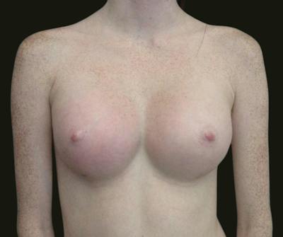 Breast Augmentation Before & After Gallery - Patient 615407 - Image 2