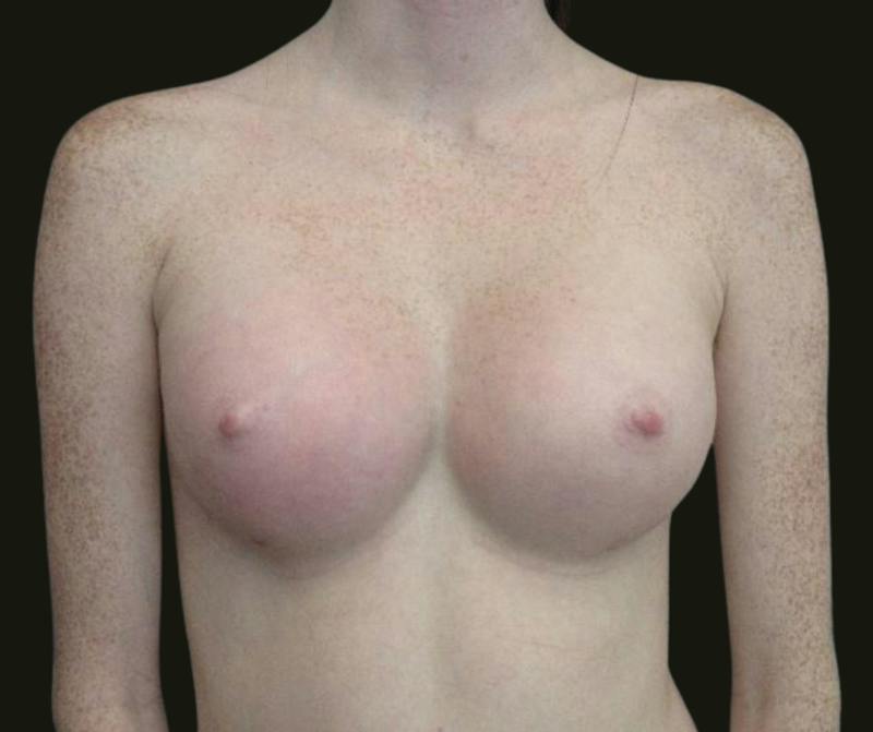 Breast Augmentation Before & After Gallery - Patient 615407 - Image 2