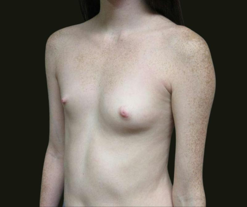 Breast Augmentation Before & After Gallery - Patient 615407 - Image 3