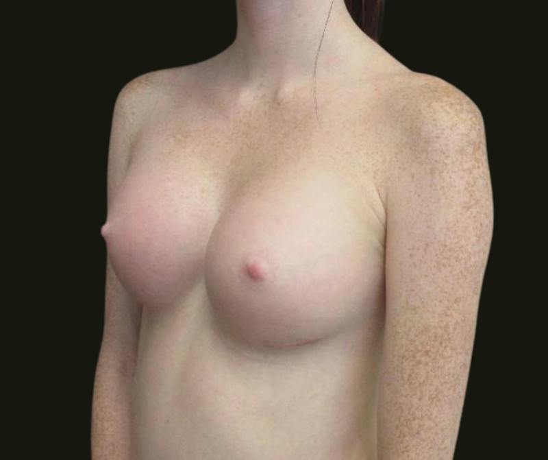 Breast Augmentation Before & After Gallery - Patient 615407 - Image 4