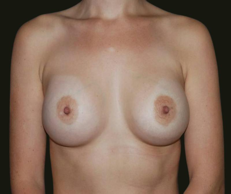 Breast Augmentation Before & After Gallery - Patient 749511 - Image 2
