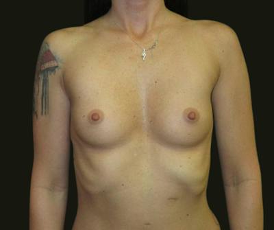 Breast Augmentation Before & After Gallery - Patient 226634 - Image 1