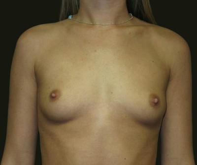Breast Augmentation Before & After Gallery - Patient 601063 - Image 1