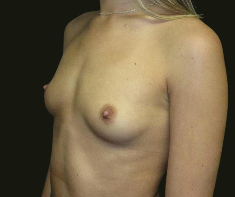 Breast Augmentation Before & After Gallery - Patient 601063 - Image 3