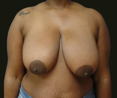 Breast Reduction Before & After Gallery - Patient 206002 - Image 1