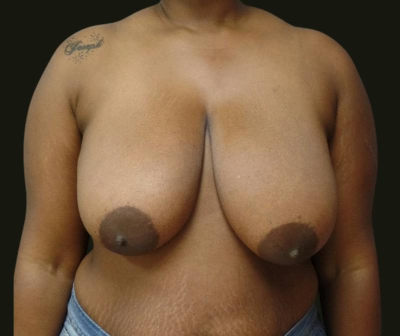 Breast Reduction Before & After Gallery - Patient 206002 - Image 1