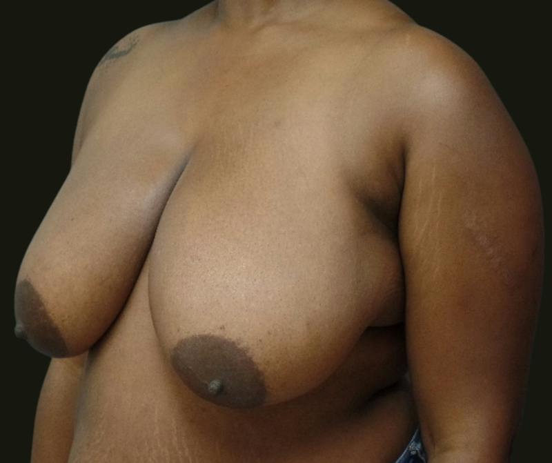 Breast Reduction Before & After Gallery - Patient 206002 - Image 3