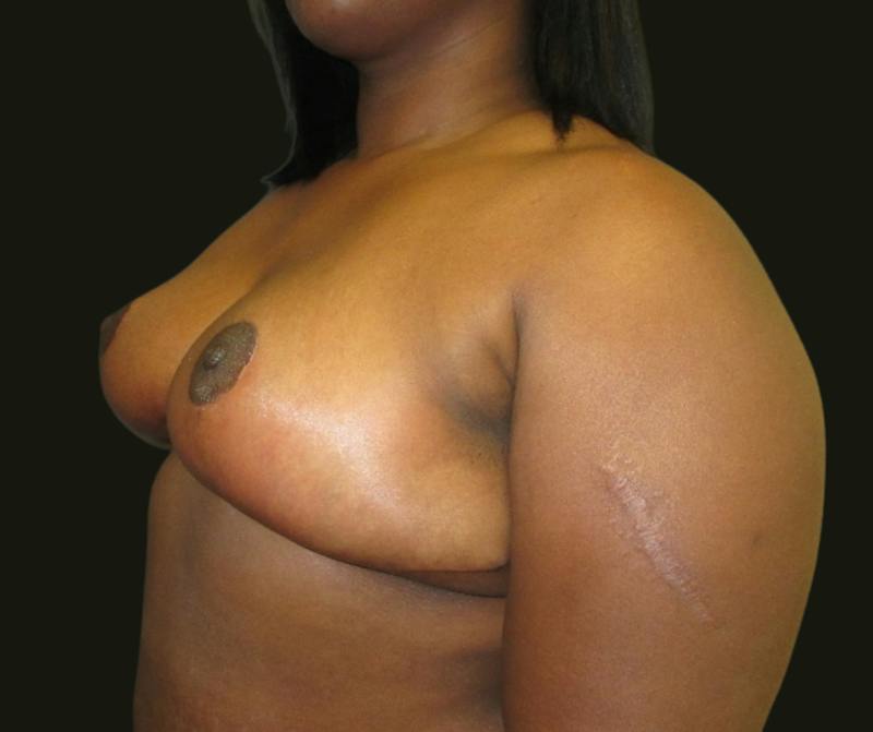 Breast Reduction Before & After Gallery - Patient 206002 - Image 4