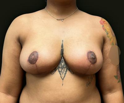 Breast Reduction Before & After Gallery - Patient 297555 - Image 2