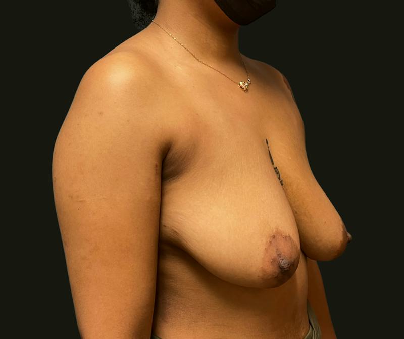 Breast Reduction Before & After Gallery - Patient 297555 - Image 3