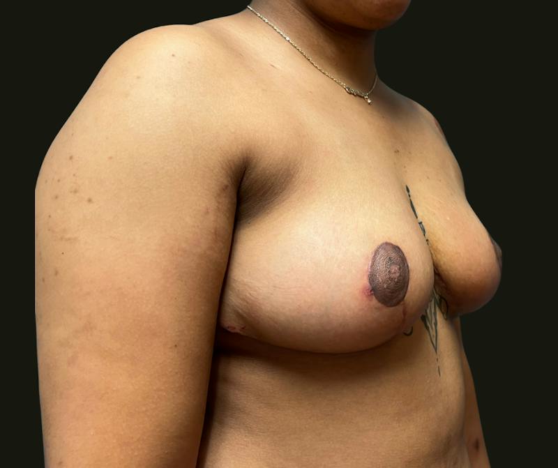 Breast Reduction Before & After Gallery - Patient 297555 - Image 4