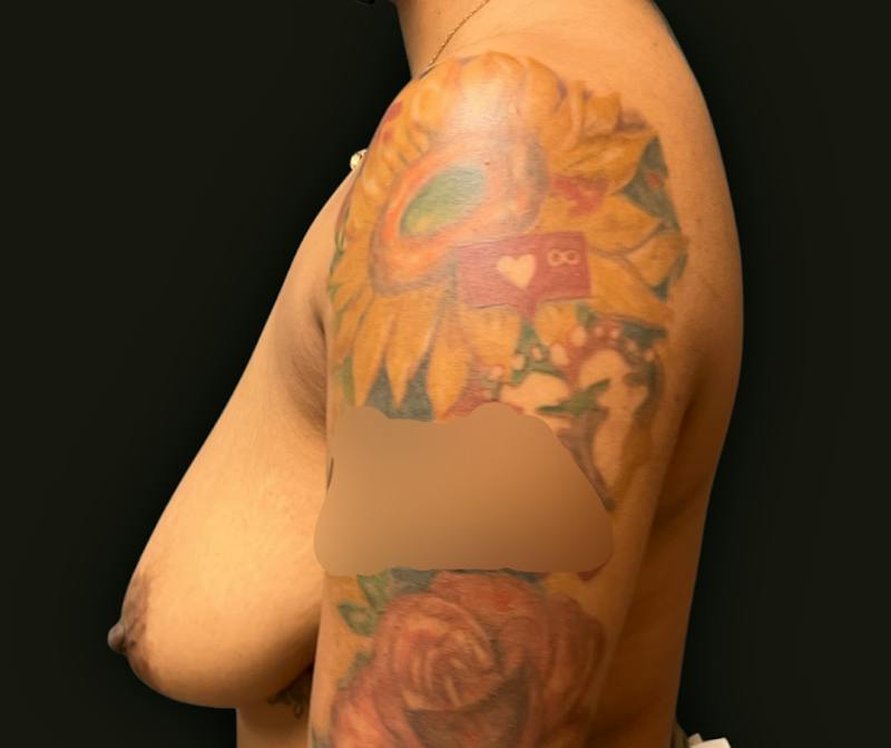 Breast Reduction Before & After Gallery - Patient 297555 - Image 5