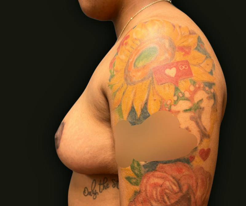 Breast Reduction Before & After Gallery - Patient 297555 - Image 6
