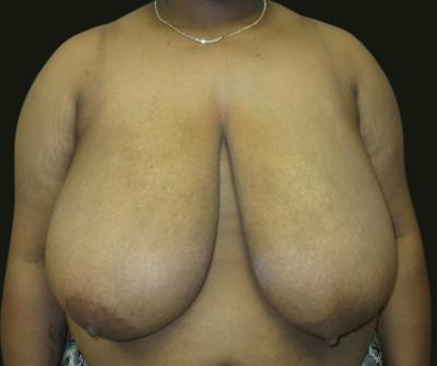 Breast Reduction Before & After Gallery - Patient 118466 - Image 1