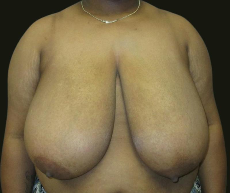Breast Reduction Before & After Gallery - Patient 118466 - Image 1