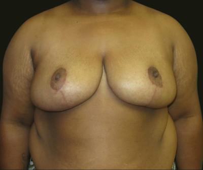 Breast Reduction Before & After Gallery - Patient 118466 - Image 2