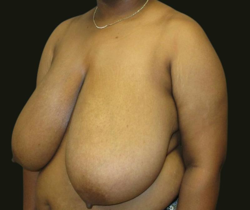 Breast Reduction Before & After Gallery - Patient 118466 - Image 3
