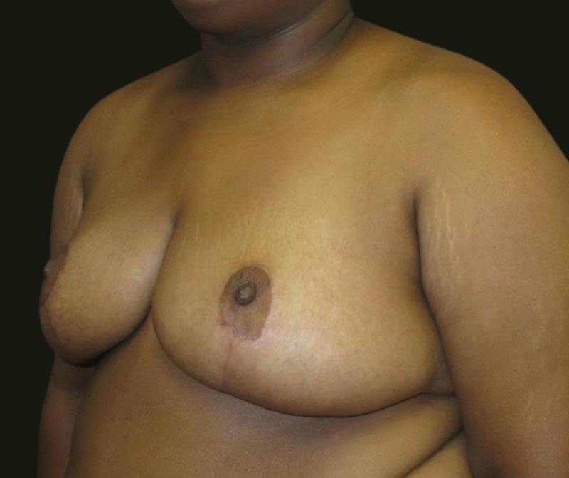 Breast Reduction Before & After Gallery - Patient 118466 - Image 4
