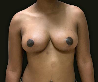 Breast Reduction Before & After Gallery - Patient 199450 - Image 2