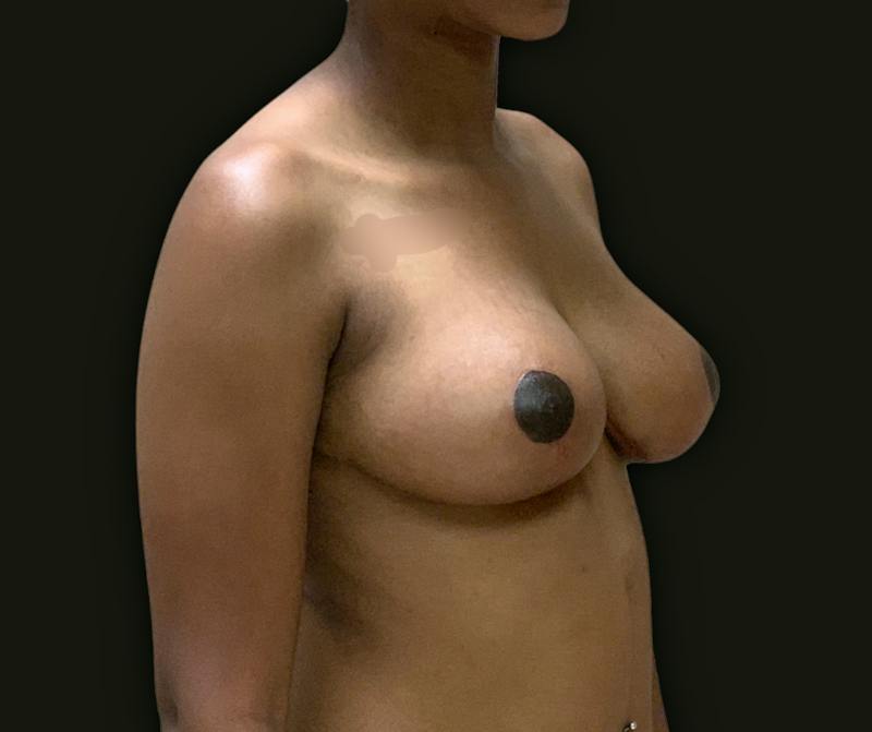 Breast Reduction Before & After Gallery - Patient 199450 - Image 4