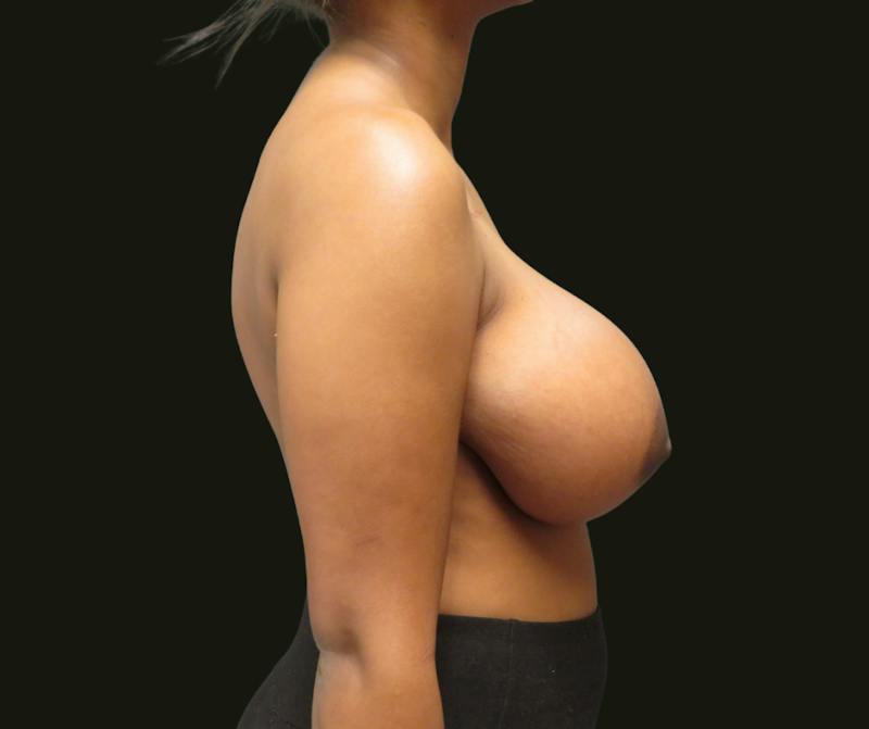 Breast Reduction Before & After Gallery - Patient 199450 - Image 5
