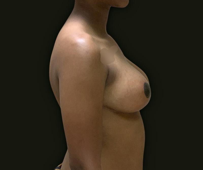 Breast Reduction Before & After Gallery - Patient 199450 - Image 6