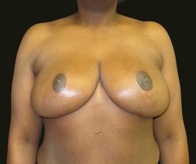 Breast Reduction Before & After Gallery - Patient 329393 - Image 2
