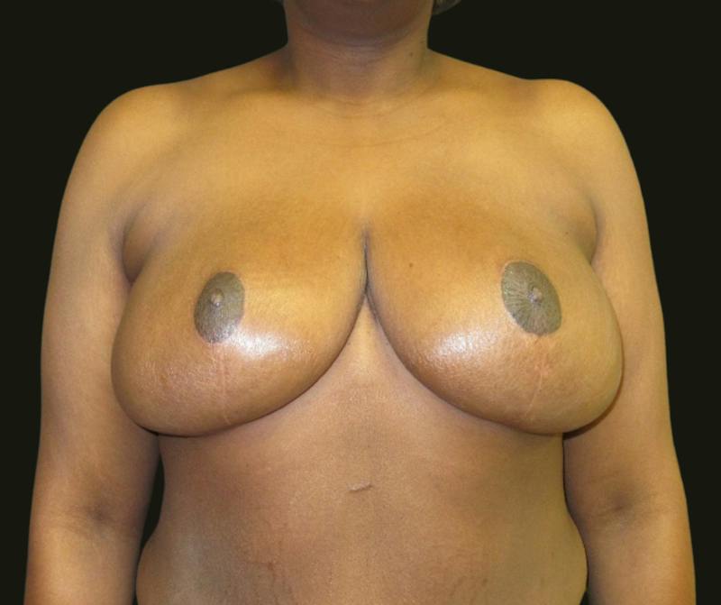 Breast Reduction Before & After Gallery - Patient 329393 - Image 2