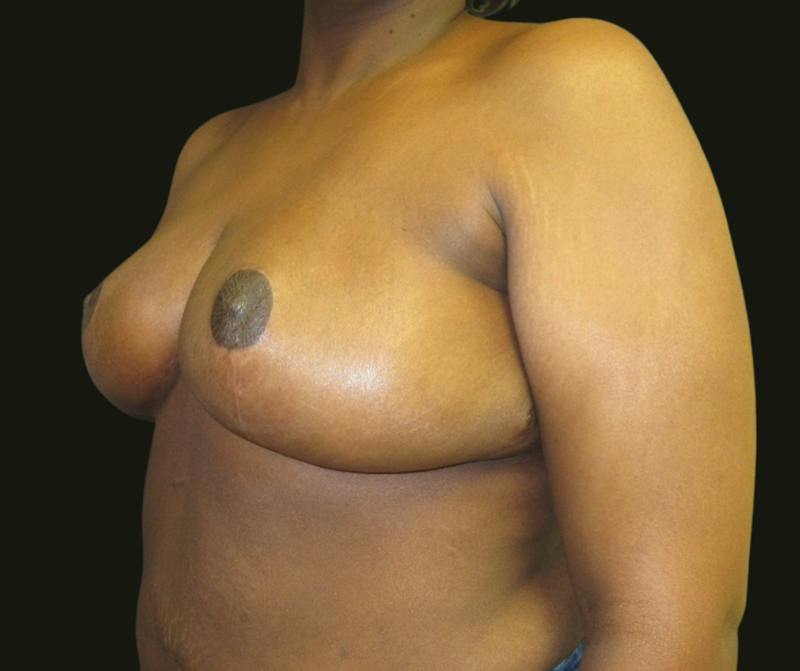 Breast Reduction Before & After Gallery - Patient 329393 - Image 4