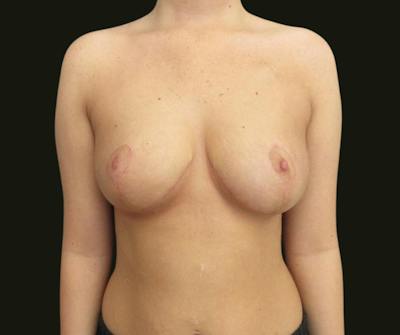 Breast Reduction Before & After Gallery - Patient 296443 - Image 2