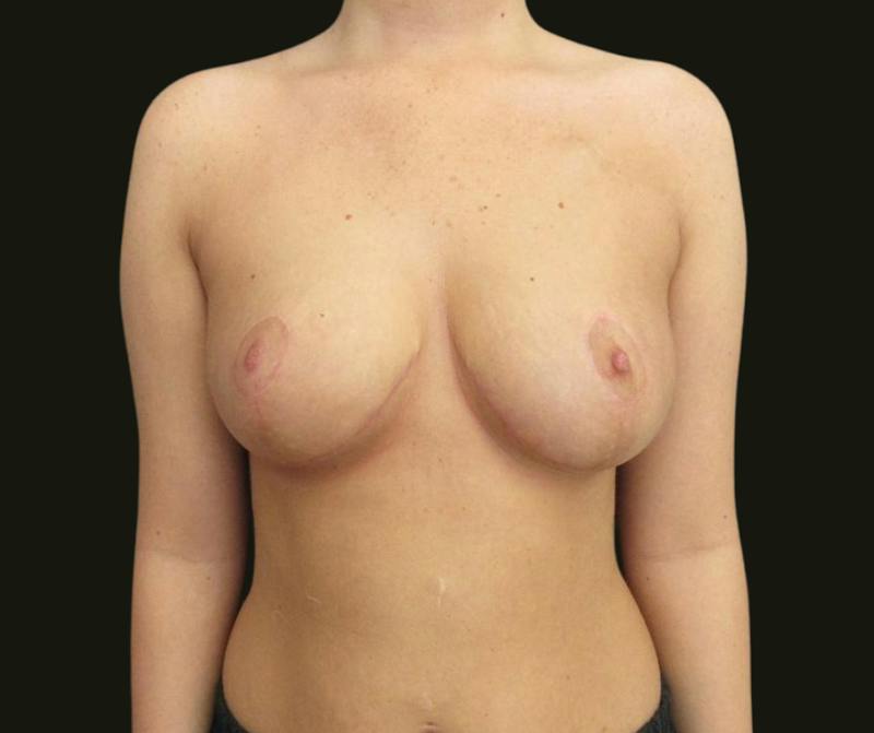 Breast Reduction Before & After Gallery - Patient 296443 - Image 2