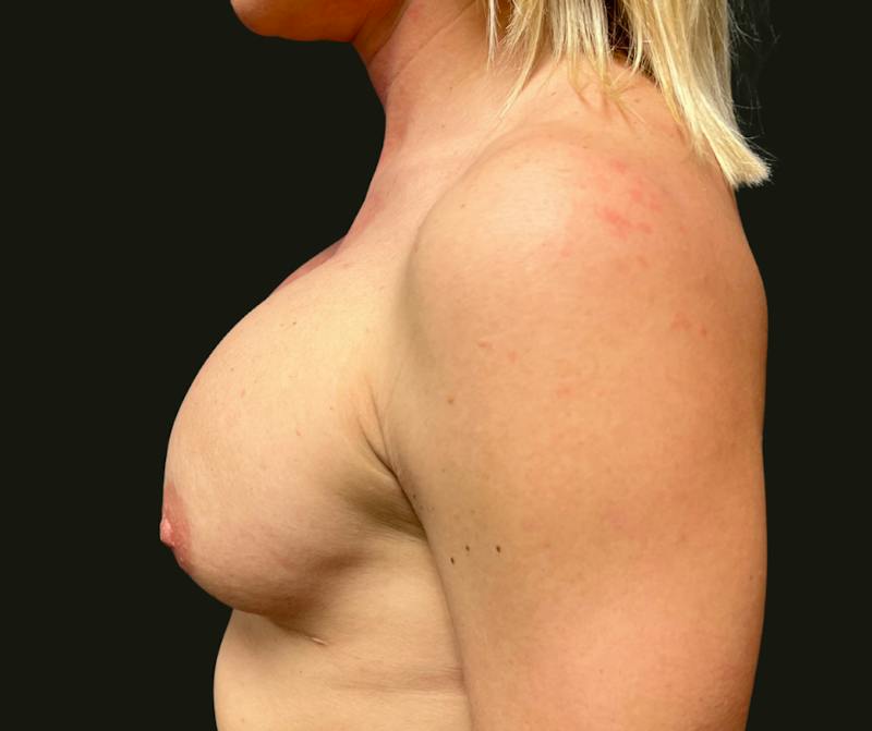 Breast Revision Before & After Gallery - Patient 101356 - Image 3