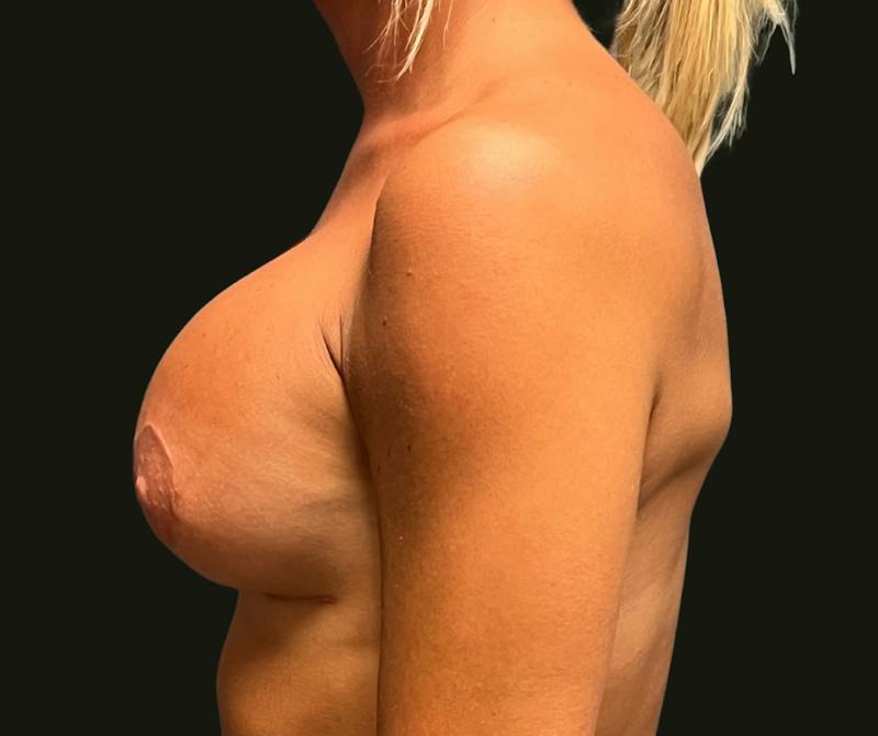 Breast Revision Before & After Gallery - Patient 101356 - Image 4