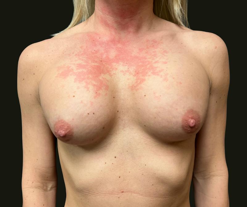 Breast Revision Before & After Gallery - Patient 101356 - Image 5