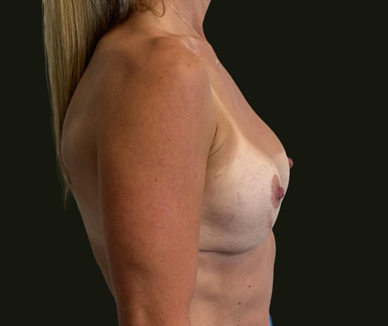 Breast Revision Before & After Gallery - Patient 720445 - Image 3