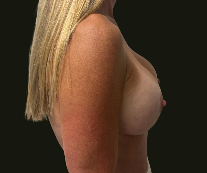 Breast Revision Before & After Gallery - Patient 720445 - Image 4