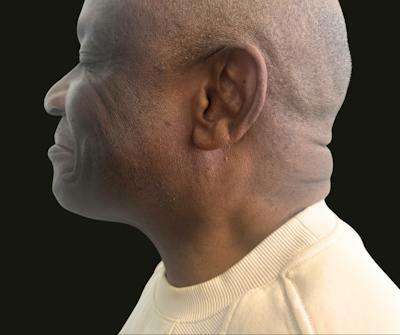 Cervicoplasty Before & After Gallery - Patient 119132 - Image 1