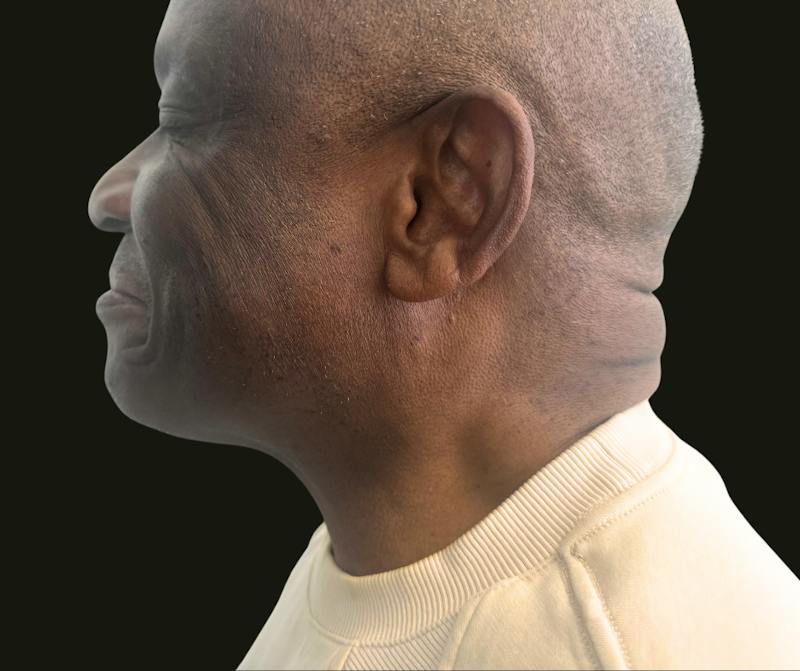 Cervicoplasty Before & After Gallery - Patient 119132 - Image 1